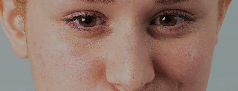 quitar puntos negros