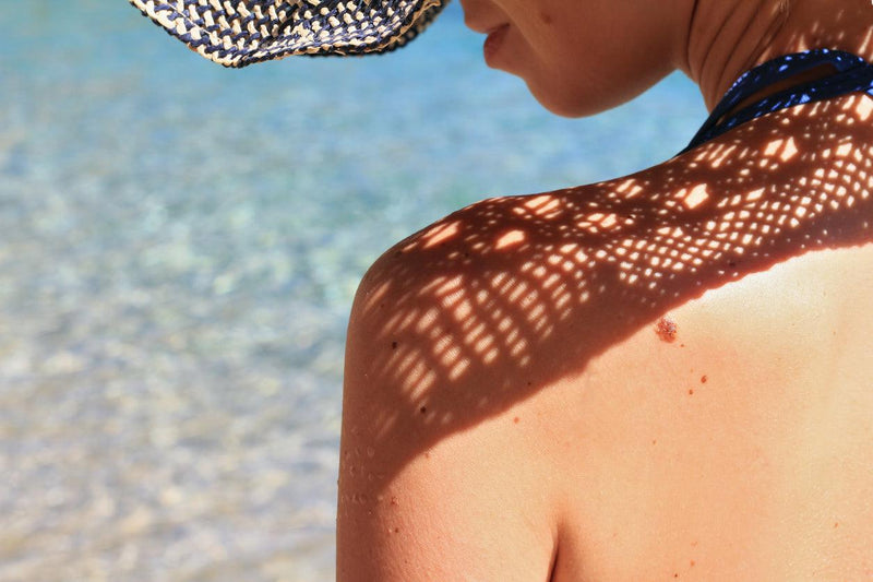 Manchas del sol en la piel del rostro y el cuerpo: ¿cómo prevenirlas?