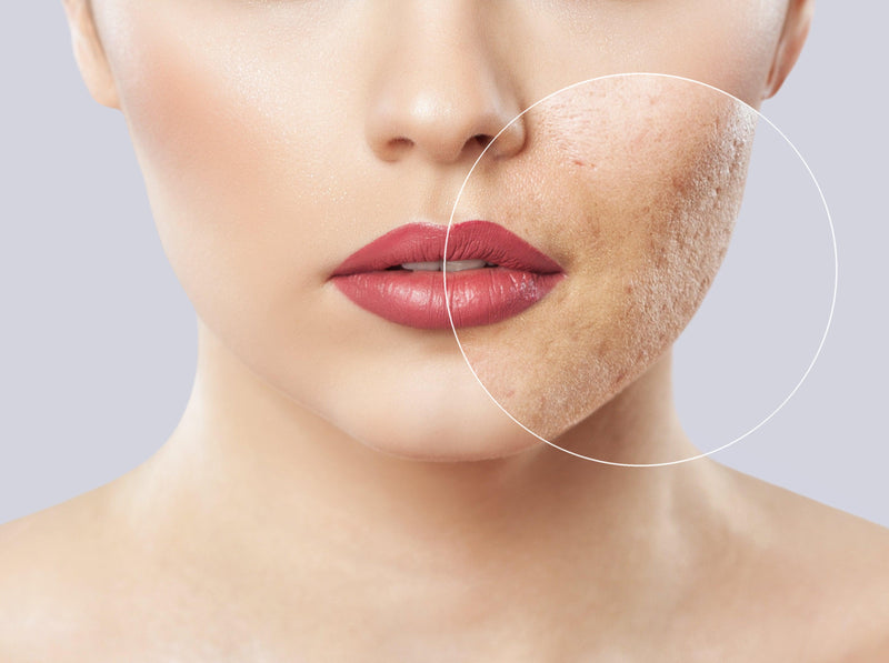 SVR acne e impurezas