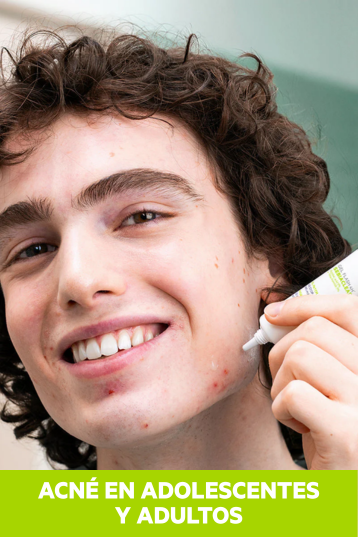 Acné en adolescentes y adultos: ¿qué lo causa y cómo combatirlo?
