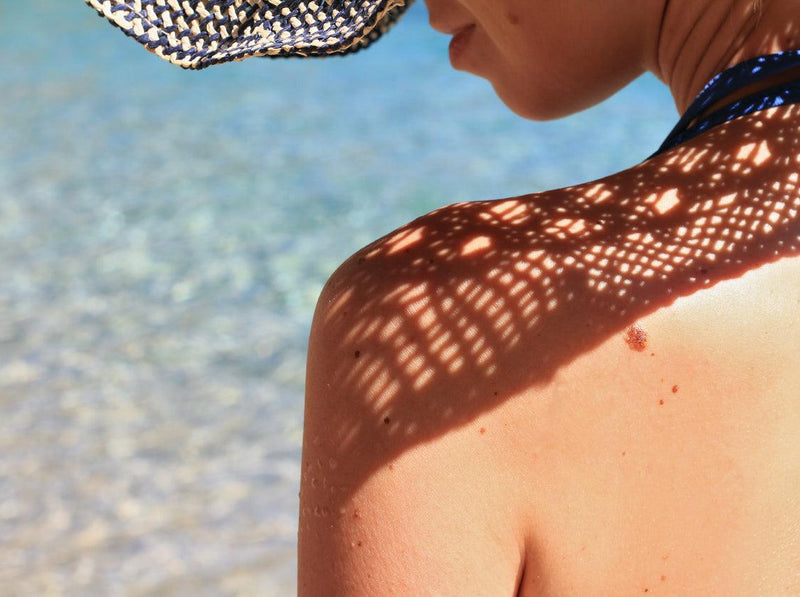 Manchas del sol en la piel del rostro y el cuerpo: ¿cómo prevenirlas?