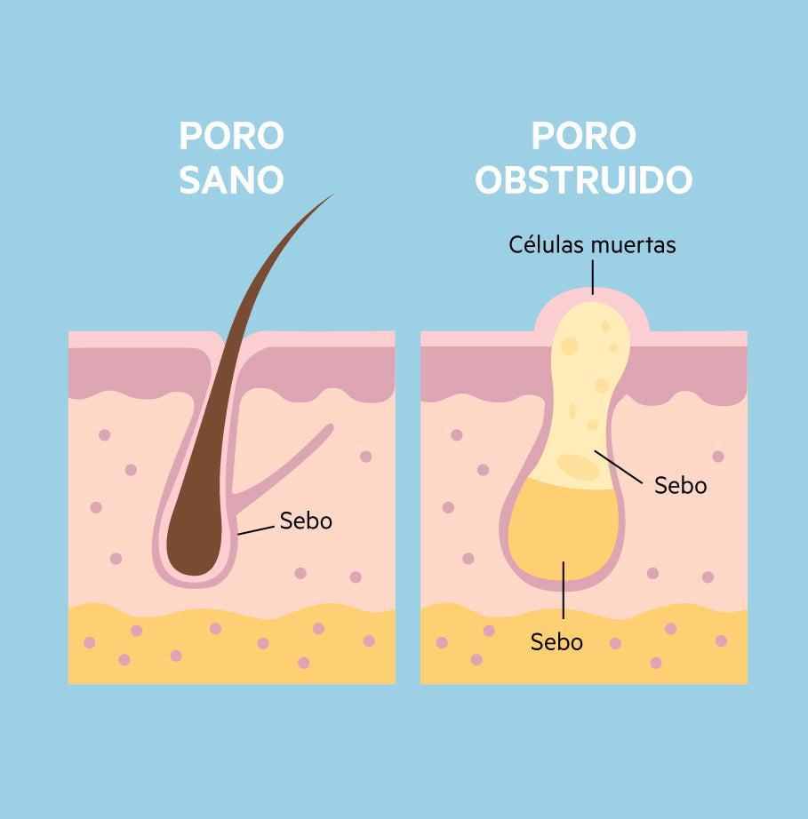 Acne Infectado Acné en adolescentes y adultos: ¿qué lo causa y cómo combatirlo?